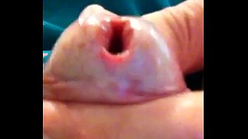 Dilatation peehole with sound 35 trim.C51CDD7B-3D8C-4271-99ED-92F81B926AFA.MOV